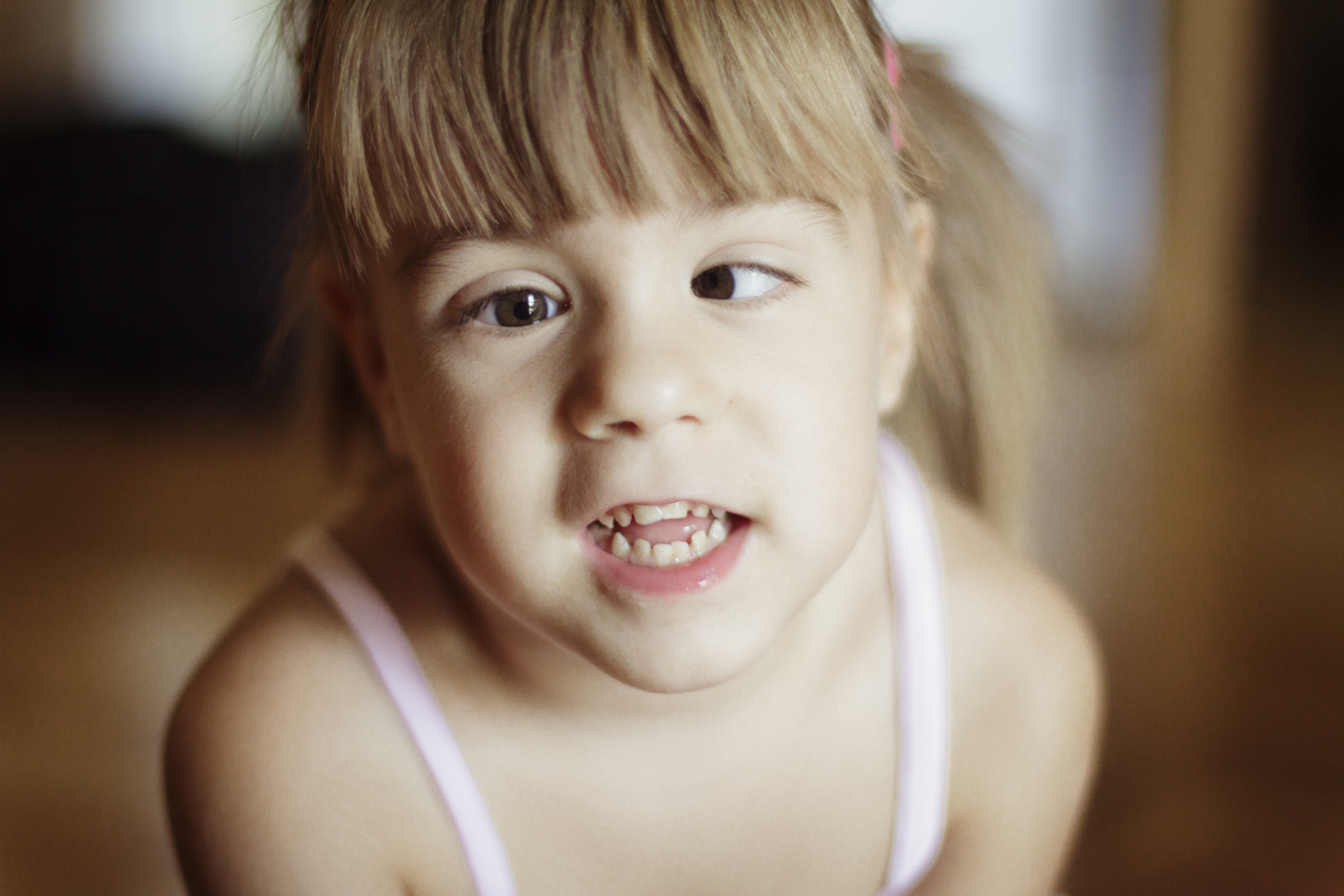 Strabismus feature